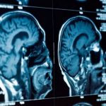 Une expérience de stimulation (TMS) cérébrale soulage la dépression